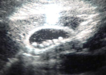 gallbladder stones ultrasound. Ultrasound of my Gallbladder